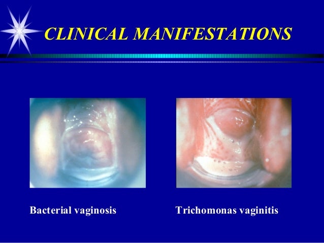 Diagnosisand treatmentofvaginitistaylor09 15-10withdisclosure