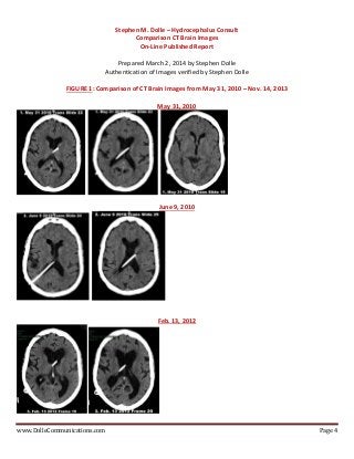 www.DolleCommunications.com Page 4
Stephen M. Dolle – Hydrocephalus Consult
Comparison CT Brain Images
On-Line Published R...