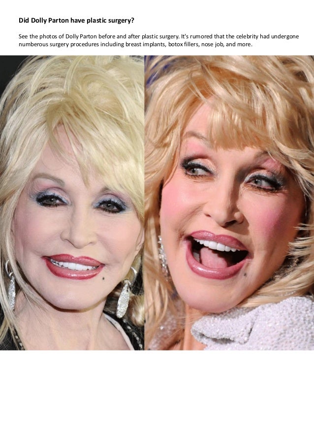 dolly parton plastic surgery