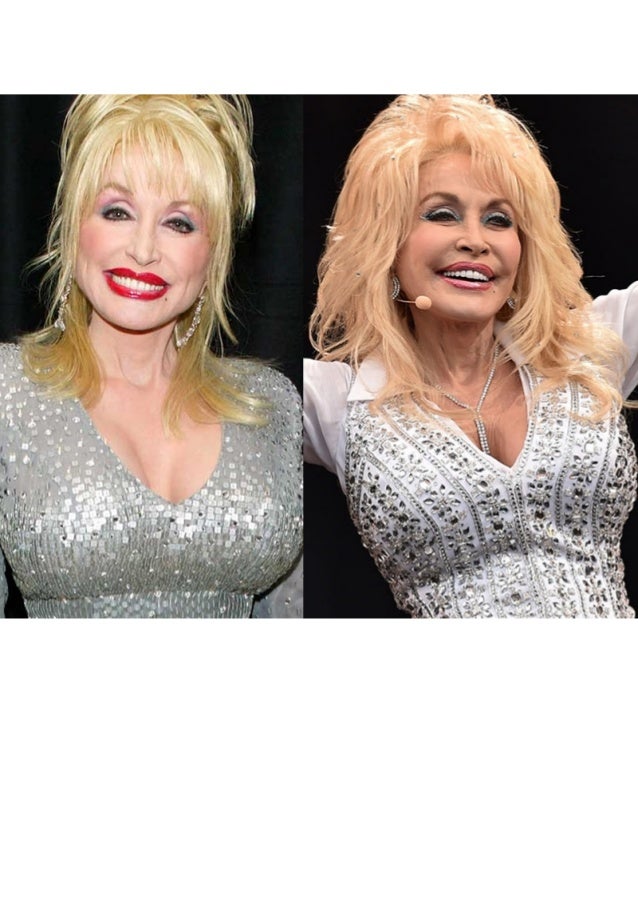 Dolly Parton Plastic Surgery Pictures Before & After