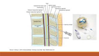 DeLeon, A; Wong, C. (2016). Spinal anesthesia: Technique. Up to Date: Topic 105456 Version 5.0
 