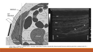 T. M. N. Tran, J. J. Ivanusic, P. Hebbard, and M. J. Barrington. Determination of spread of injectate after ultrasound-guided transversus abdominis plane block: a cadaveric study: Br. J.
Anaesth. (2009) 102 (1): 123-127
 
