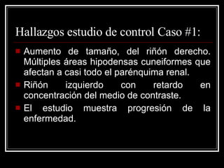 Hallazgos estudio de control Caso #1: Aumento de tamaño, del riñón derecho. Múltiples áreas hipodensas cuneiformes que afectan a casi todo el parénquima renal.  Riñón izquierdo con retardo en concentración del medio de contraste.  El estudio muestra progresión de la enfermedad.  