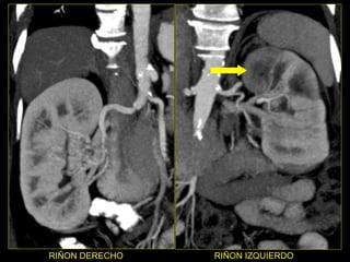 RIÑON DERECHO RIÑON IZQUIERDO 