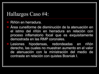 Hallazgos Caso #4: Riñón en herradura. Área cuneiforme de disminución de la atenuación en el istmo del riñón en herradura en relación con proceso inflamatorio focal que es exquisitamente demostrada en las RMP coronales.  Lesiones hipodensas, redondeadas en riñón derecho, las cuales no muestran aumento en el valor de atenuación con la ministración del medio de contraste en relación con quistes Bosniak I.  