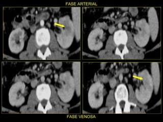 FASE ARTERIAL FASE VENOSA 