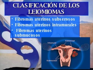 CLASIFICACIÓN DE LOS LEIOMIOMAS <ul><li>Fibromas uterinos subserosos   </li></ul><ul><li>Fibromas uterinos intramurales </...
