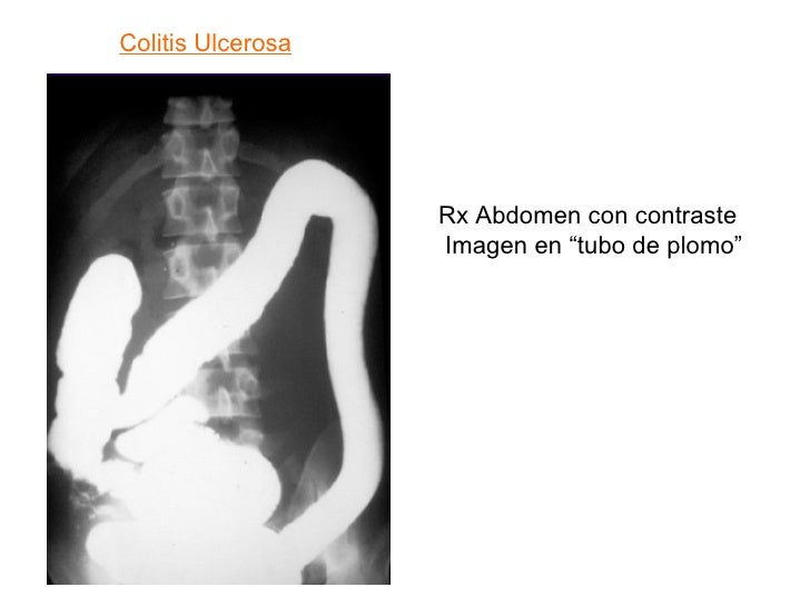 Colitis ulcerosa partnersuche