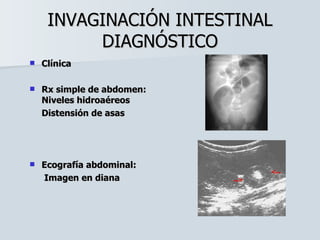 INVAGINACIÓN INTESTINAL DIAGNÓSTICO Clínica Rx simple de abdomen: Niveles hidroaéreos Distensión de asas Ecografía abdominal:   Imagen en diana 