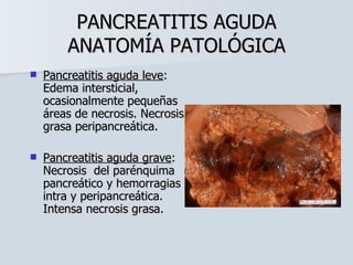 PANCREATITIS AGUDA ANATOMÍA PATOLÓGICA Pancreatitis aguda leve : Edema intersticial, ocasionalmente pequeñas áreas de necrosis. Necrosis grasa peripancreática. Pancreatitis aguda grave : Necrosis  del parénquima pancreático y hemorragias intra y peripancreática. Intensa necrosis grasa. 