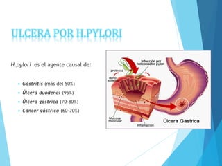 ULCERA POR H.PYLORI
H.pylori es el agente causal de:
 Gastritis (más del 50%)
 Úlcera duodenal (95%)
 Úlcera gástrica (70-80%)
 Cancer gástrico (60-70%)
 