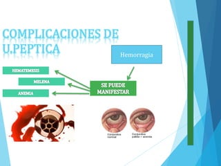 COMPLICACIONES DE
U.PEPTICA Hemorragia
 