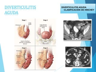 DIVERTICULITIS
AGUDA
DIVERTICULITIS AGUDA
CLASIFICACIÓN DE HINCHEY
 