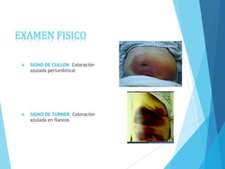 EXAMEN FISICO
 SIGNO DE CULLEN: Coloración
azulada periumbilical
 SIGNO DE TURNER: Coloración
azulada en flancos
 