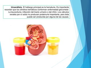 Uroanálisis. El hallazgo principal es la hematuria. Es importante
recordar que los cilindros hemáticos conforman enfermedad glorumelar.
La leucocituria, infección del tracto urinario o del riñón. Los cálculos
renales por sí solos no producen proteinuria importante, pero ésta
puede ser producida por alguna de las causas.
 