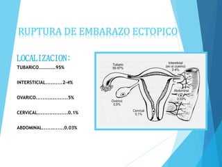 RUPTURA DE EMBARAZO ECTOPICO
LOCALIZACION:
TUBARICO…………..95%
INTERSTICIAL..........2-4%
OVARICO...................5%
CERVICAL..................0.1%
ABDOMINAL.............0.03%
 