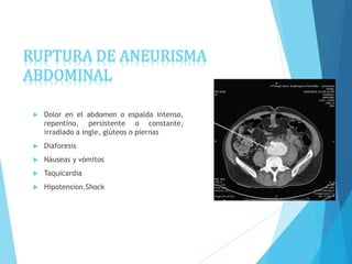 RUPTURA DE ANEURISMA
ABDOMINAL
 Dolor en el abdomen o espalda intenso,
repentino, persistente o constante,
irradiado a ingle, glúteos o piernas
 Diaforesis
 Náuseas y vómitos
 Taquicardia
 Hipotension,Shock
 