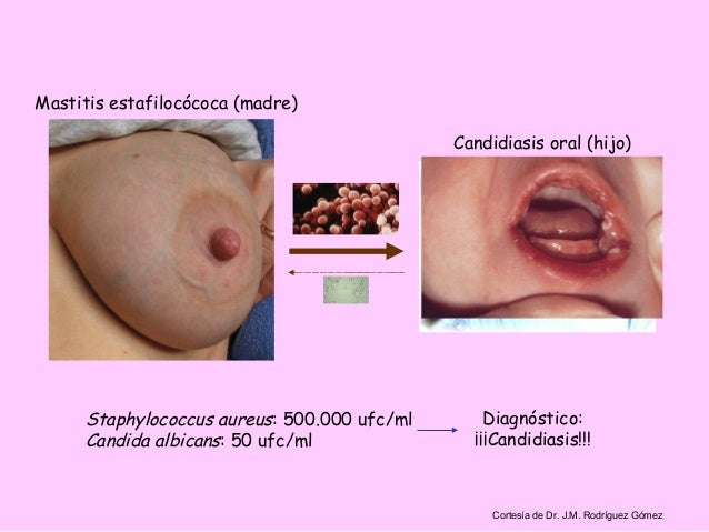Atopichesky la dermatitis a los niños el tratamiento por la medicina pública