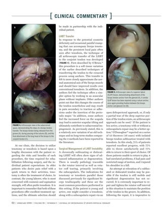 [       CLINICAL COMMENTARY                              ]
                                                          be made in partnership with the indi-
                                                          vidual patient.



                                                          In response to the potential cosmetic
                                                          deformity and occasional painful cramp-
                                                          ing that can accompany biceps tenoto-
                                                          my, and the persistent local pain often
                                                          seen after tenodesis, the technique of
                                                          all arthroscopic transfer of the LHBT
                                                          to the conjoint tendon was developed
                                                          (         ). First described by O’Brien,74
                                                          this procedure is a soft tissue variation
                                                          of the earlier described techniques of
                                                          transferring the tendon to the coracoid
                                                          process using anchors. This transfer is
                                                          felt to more closely approximate the nor-
                                                          mal anatomical axis of the biceps muscle
                                                          and should have improved results over
                                                          conventional tenodesis. In addition, the
                                                          authors feel the technique offers a sim-                 Arthroscopic view of a superior labral
                                                                                                        (SLAP) lesion, demonstrating detachment of the
                                                          pler option by working in an avascular
                                                                                                        biceps tendon anchor from the glenoid (A). A similar
                                                          plane without implants. Other authors         SLAP lesion has been repaired using a suture anchor,
                                                          point out that this changes the course of     once again providing ﬁxation between the biceps
                                                          the tendon nonetheless and may result         anchor and glenoid rim (B).
                                                          in pain secondary to traction or adhe-
                                                          sions under the insertion of the pecto-      open deltopectoral approach, or, if only
                                                          ralis major.1 In addition, some authors      a partial tear of the deep superior por-
                                                          feel the increased force on the scapula      tion of the tendon exists, an arthroscopic
                                                          may lead to anterior scapular tilting and    approach can be used. 3 If the patient is
            Arthroscopic view in the subacromial          ultimately contribute to subacromial im-     less active, a tenotomy with or without a
space, demonstrating the steps of a biceps tendon
                                                          pingement. As previously stated, this is     subscapularis repair may be a better op-
transfer. The biceps tendon being released from the
groove (A), during passing of the sutures (B), and the
                                                          a relatively new variation of an old tech-   tion.6 O’Donoghue56 reported on a series
ﬁnal attachment of the long head of the biceps to the     nique and no long-term studies compar-       of 53 throwers (56 cases) with isolated
conjoint tendon (C).                                      ing the 2 methods have been reported in      biceps tendon subluxation treated with
                                                          the literature.                              tenodesis. In this study, 71% of patients
    At our clinic, the decision to utilize                                                             reported excellent progress, with 77%
tenotomy or tenodesis is based upon a                                                                  able to throw satisfactorily and 77%
lengthy discussion with the patient re-                   A chronically subluxating or dislocat-       able to return to their sport of choice. Of
garding the risks and beneﬁts of each                     ing LHBT will often show signs of ad-        those patients unable to return to play, 4
procedure, the time required for reha-                    vanced inﬂammation or degeneration.          had unrelated problems, 6 had pain and
bilitation following surgery, and the in-                 There is usually pathology traceable         restricted range of motion, and 1 injured
dividual patient expectations. In older                   to the rotator interval as well as rota-     his shoulder in a fall.
patients who desire pain relief with a                    tor cuff tearing, primarily involving            An attempt at relocation of a sublux-
quick return to their activities, teno-                   the subscapularis. The indications for       ated or dislocated tendon may be pos-
tomy is often the treatment of choice. In                 tenotomy or tenodesis parallel those         sible if the tendon is still mobile and
contrast, the young laborer, who is most                  discussed previously for signiﬁcant bi-      signiﬁcant degeneration has not oc-
concerned with cosmesis and supination                    ceps tendinopathy and these are the          curred. It is extremely important to re-
strength, will often prefer tenodesis. It is              most common procedures performed in          pair and tighten the rotator cuff interval
important to remember that both of these                  this setting. If the patient is young and    in this situation to maintain the position
procedures offer excellent treatment op-                  active, one might consider a tenodesis;      of the tendon in the groove. In addition,
tions, and the ultimate selection should                  along with a subscapularis repair via an     following the repair, it is imperative to


62 | february 2009 | volume 39 | number 2 | journal of orthopaedic & sports physical therapy
 