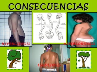CONSECUENCIAS




HIPERCIFOSIS                HIPERLORDOSIS




               ESCOLIOSIS
 