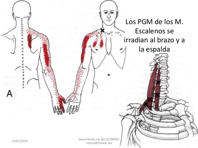Dolor de origen muscular