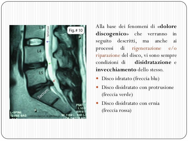Degenerazione Vacuolare Del Disco L5 S1