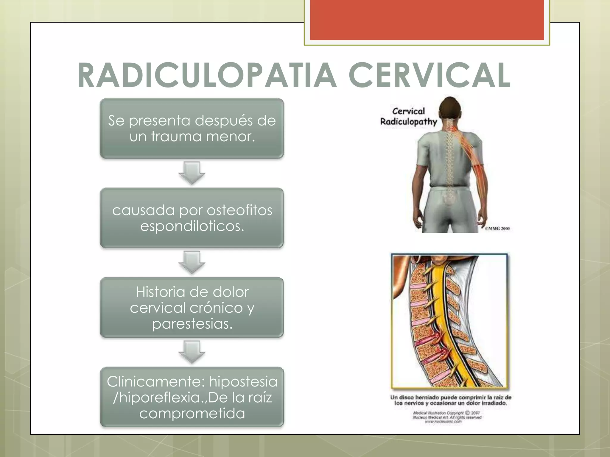 RADICULOPATIA CERVICAL
 Se presenta después de
    un trauma menor.




 causada por osteofitos
    espondiloticos.



     Historia de dolor
    cervical crónico y
        parestesias.



 Clinicamente: hipostesia
  /hiporeflexia.,De la raíz
      comprometida
 