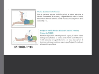 SACROILEITIS
 