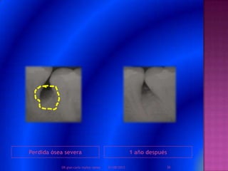 Perdida ósea severa 1 año después
01/08/2013 36DR.gian carlo muñoz ramos
 