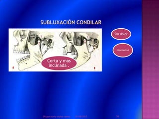 Sin dolor
Hiperlaxitud
Corta y mas
inclinada .
01/08/2013 56DR.gian carlo muñoz ramos
 