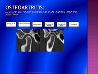 Perforación del
disco.
Contacto superficies
óseas.
Condromalacia.
Superficies óseas
erosionan y
aplanan.
Dolor articular
mas fuerte de
noche
Crepitacion
01/08/2013 57DR.gian carlo muñoz ramos
 