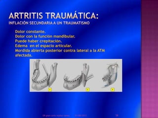 Dolor constante.
Dolor con la función mandibular.
Puede haber crepitación.
Edema en el espacio articular.
Mordida abierta posterior contra lateral a la ATM
afectada.
01/08/2013 58DR.gian carlo muñoz ramos
 