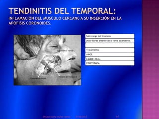 Sobrecarga del bruxismo.
Dolor borde anterior de la rama ascendente.
Tratamiento.
AINES.
CALOR LOCAL.
FISIOTERAPIA
01/08/2013 61DR.gian carlo muñoz ramos
 