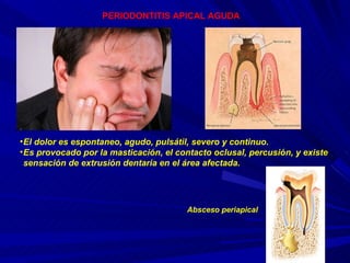 PERIODONTITIS APICAL AGUDA El dolor es espontaneo, agudo, pulsátil, severo y continuo. Es provocado por la masticación, el contacto oclusal, percusión, y existe sensación de extrusión dentaria en el área afectada. Absceso periapical 