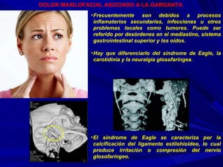 DOLOR MAXILOFACIAL ASOCIADO A LA GARGANTA   Frecuentemente son debidos a procesos inflamatorios secundarios, infecciones u otros problemas locales como tumores. Puede ser referido por desórdenes en el mediastino, sistema gastrointestinal superior y los oídos. Hay que diferenciarlo del síndrome de Eagle, la carotidinia y la neuralgia glosofaríngea. El síndrome de Eagle se caracteriza por la calcificación del ligamento estilohioideo, lo cual produce irritación o compresión del nervio glosofaríngeo. 