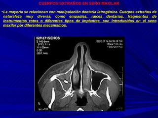 La mayoría se relacionan con manipulación dentaria iatrogénica. Cuerpos extraños de naturaleza muy diversa, como  empastes, raíces dentarias, fragmentos de instrumentos rotos o diferentes tipos de implantes, son introducidos en el seno maxilar por diferentes mecanismos. CUERPOS EXTRAÑOS EN SENO MAXILAR 