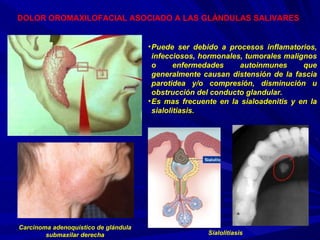 DOLOR OROMAXILOFACIAL ASOCIADO A LAS GLÁNDULAS SALIVARES   Puede ser debido a procesos inflamatorios, infecciosos, hormonales, tumorales malignos o enfermedades autoinmunes que generalmente causan distensión de la fascia parotidea y/o compresión, disminución u obstrucción del conducto glandular. Es mas frecuente en la sialoadenitis y en la sialolitiasis. Sialolitiasis Carcinoma adenoquístico de glándula submaxilar derecha 