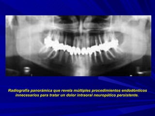 Radiografía panorámica que revela múltiples procedimientos endodónticos innecesarios para tratar un dolor intraoral neuropático persistente.   