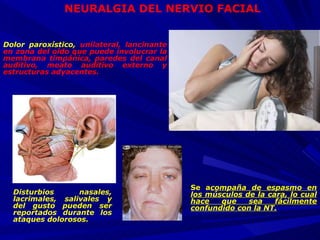 NEURALGIA DEL NERVIO FACIAL Dolor paroxístico,  unilateral, lancinante en zona del oído que puede involucrar la membrana t...