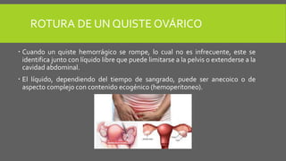 ROTURA DE UN QUISTE OVÁRICO
 Cuando un quiste hemorrágico se rompe, lo cual no es infrecuente, este se
identifica junto con líquido libre que puede limitarse a la pelvis o extenderse a la
cavidad abdominal.
 El líquido, dependiendo del tiempo de sangrado, puede ser anecoico o de
aspecto complejo con contenido ecogénico (hemoperitoneo).
 