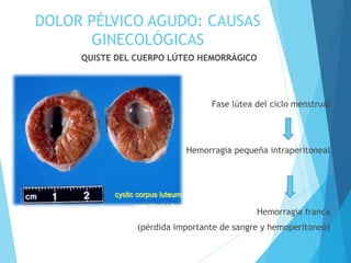 DOLOR PÉLVICO AGUDO: CAUSAS
GINECOLÓGICAS
QUISTE DEL CUERPO LÚTEO HEMORRÁGICO
Fase lútea del ciclo menstrual
Hemorragia pequeña intraperitoneal
Hemorragia franca
(pérdida importante de sangre y hemoperitoneo)
 