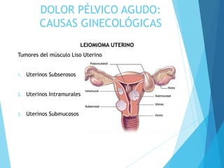 DOLOR PÉLVICO AGUDO:
CAUSAS GINECOLÓGICAS
LEIOMIOMA UTERINO
Tumores del músculo Liso Uterino
TIPOS
1. Uterinos Subserosos
2. Uterinos Intramurales
3. Uterinos Submucosos
 