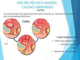 DOLOR PÉLVICO AGUDO:
CAUSAS URINARIAS
CISTITIS
Es una infección de la parte baja del tracto urinario, en concreto de la vejiga,
que es causada por bacterias.
CARACTERIZADO POR:
 Dolor Supra púbico sordo
 Micción frecuente
 Disuria
 Hematuria (en ocasiones)
 
