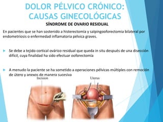 DOLOR PÉLVICO CRÓNICO:
CAUSAS GINECOLÓGICAS
SÍNDROME DE OVARIO RESIDUAL
En pacientes que se han sostenido a histerectomía y salpingooforectomia bilateral por
endometriosis o enfermedad inflamatoria pélvica graves.
 Se debe a tejido cortical ovárico residual que queda in situ después de una disección
difícil, cuya finalidad ha sido efectuar ooforectomía
 A menudo la paciente se ha sometido a operaciones pélvicas múltiples con remoción
de útero y anexos de manera sucesiva
 