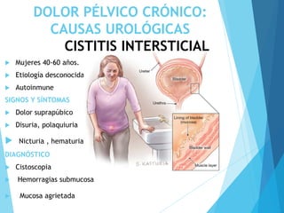 DOLOR PÉLVICO CRÓNICO:
CAUSAS UROLÓGICAS
CISTITIS INTERSTICIAL
 Mujeres 40-60 años.
 Etiología desconocida
 Autoinmune
SIGNOS Y SÍNTOMAS
 Dolor suprapúbico
 Disuria, polaquiuria
 Nicturia , hematuria
DIAGNÓSTICO
 Cistoscopia
 Hemorragias submucosa
 Mucosa agrietada
 