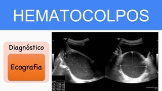 HEMATOCOLPOS
 