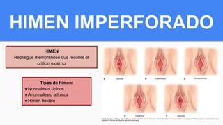 HIMEN IMPERFORADO
HIMEN
Repliegue membranoso que recubre el
orificio externo
Tipos de himen:
★Normales o típicos
★Anormales o atípicos
★Himen flexible
 