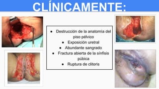 CLÍNICAMENTE:
● Destrucción de la anatomía del
piso pélvico
● Exposición uretral
● Abundante sangrado
● Fractura abierta de la sínfisis
púbica
● Ruptura de clitoris
 