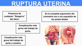 RUPTURA UTERINA
Presencia de
cualquier ‘’Desgarro’’
del útero.
Complicación más
grave del trabajo de
parto.
Complicación más
grave del trabajo de
parto o cesárea.
Es la completa separación del
miometrio con o sin expulsión de
las partes fetales
 