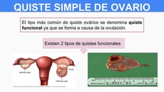 QUISTE SIMPLE DE OVARIO
El tipo más común de quiste ovárico se denomina quiste
funcional ya que se forma a causa de la ovulación.
Existen 2 tipos de quistes funcionales
Quistes foliculares:
Se forman cuando el
folículo no se abre para
liberar el óvulo.
Quistes del cuerpo lúteo:
Se forman cuando el folículo
que retuvo el óvulo se sella
después de liberar el óvulo.
 